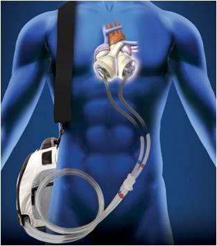 Artificial Heart Installed